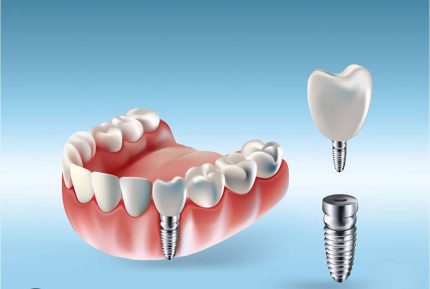 IMPLANT DENTAIRE