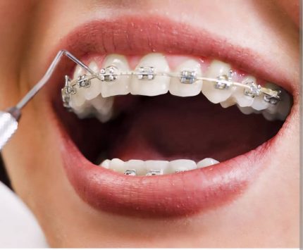 ORTHODONTIE (ODF)